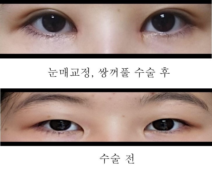 수술후기이미지