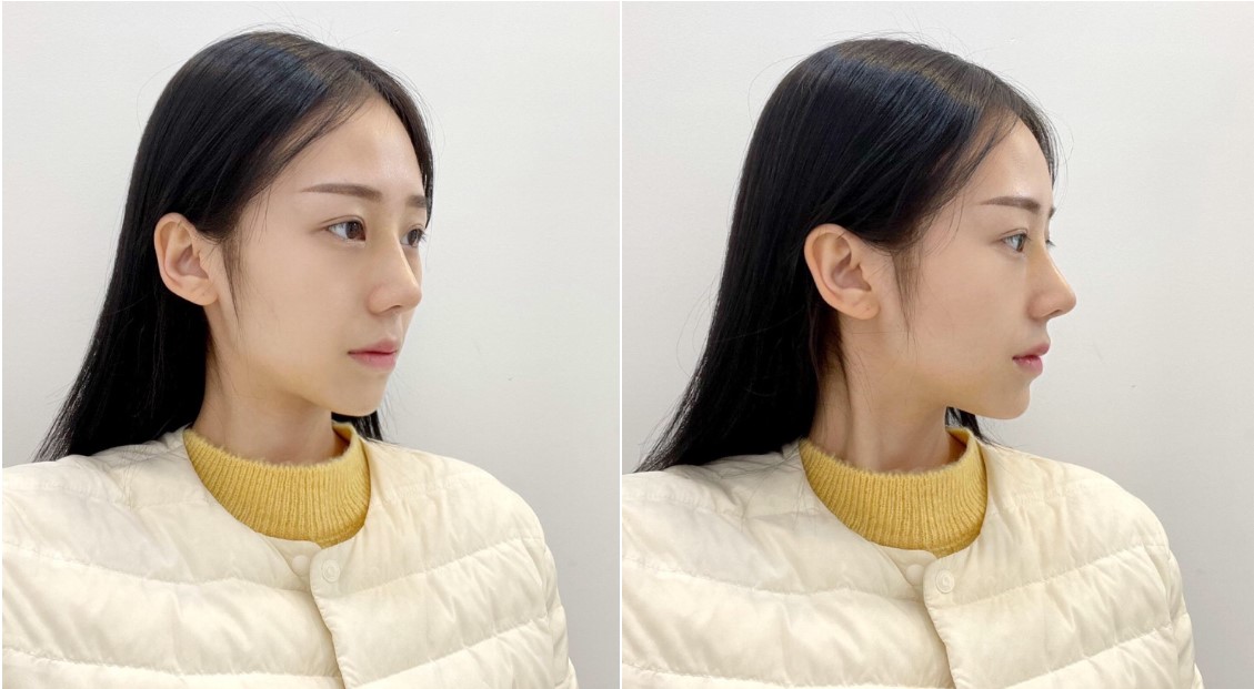 수술후기이미지