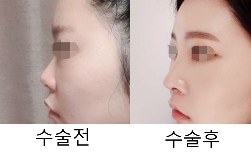 수술후기이미지