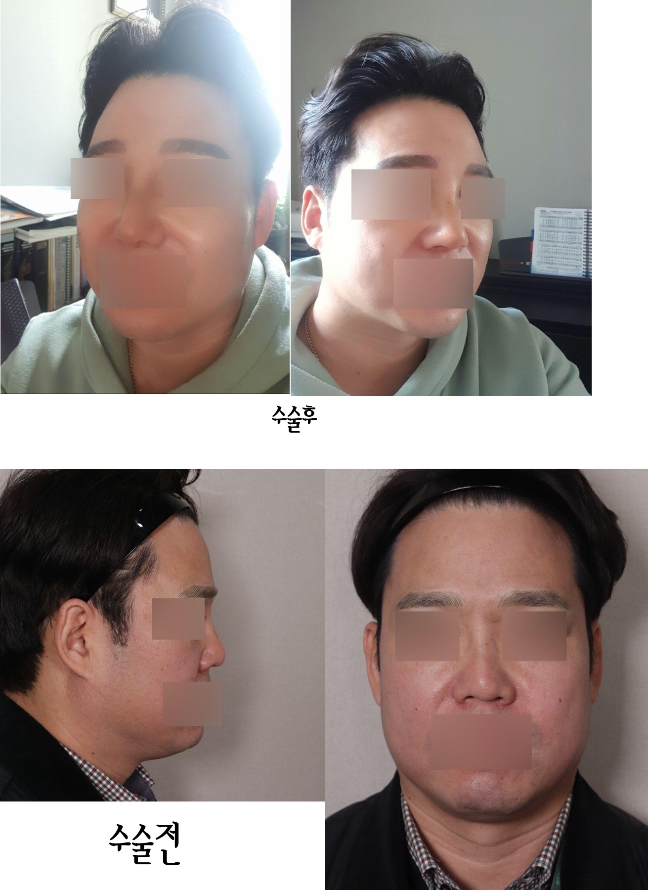 수술후기이미지