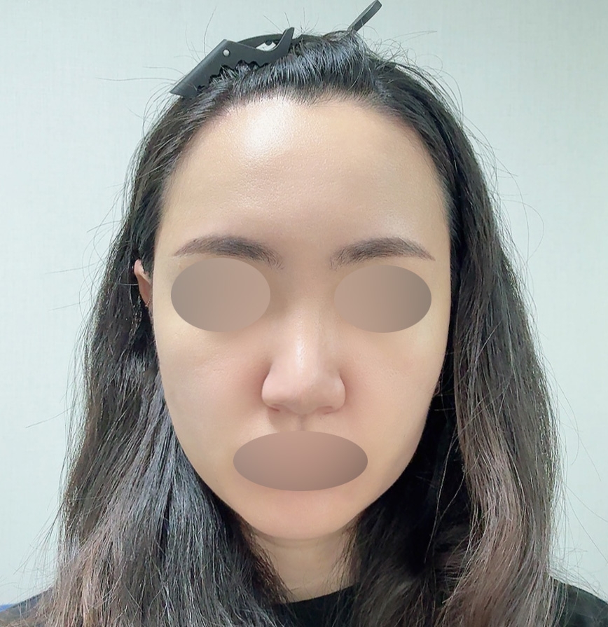 수술후기이미지