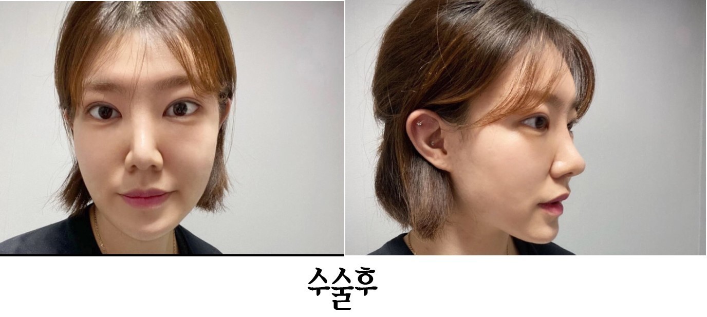 수술후기이미지