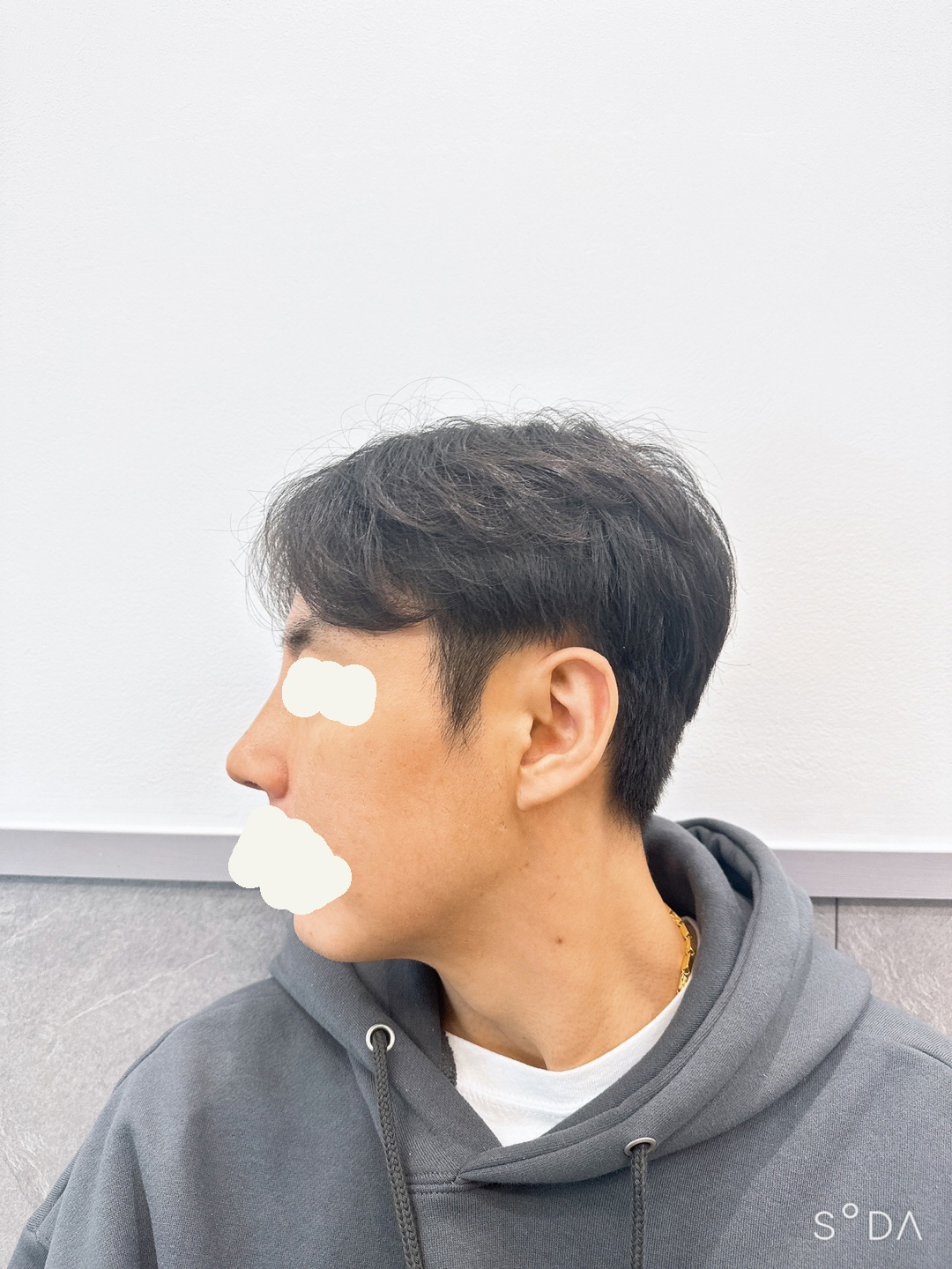 수술후기이미지