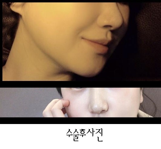 수술후기이미지