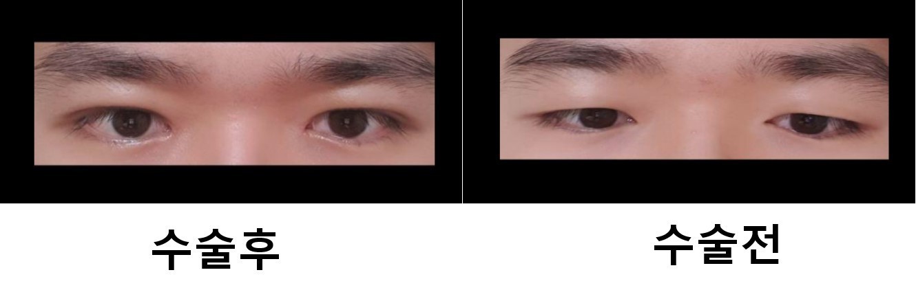 수술후기이미지