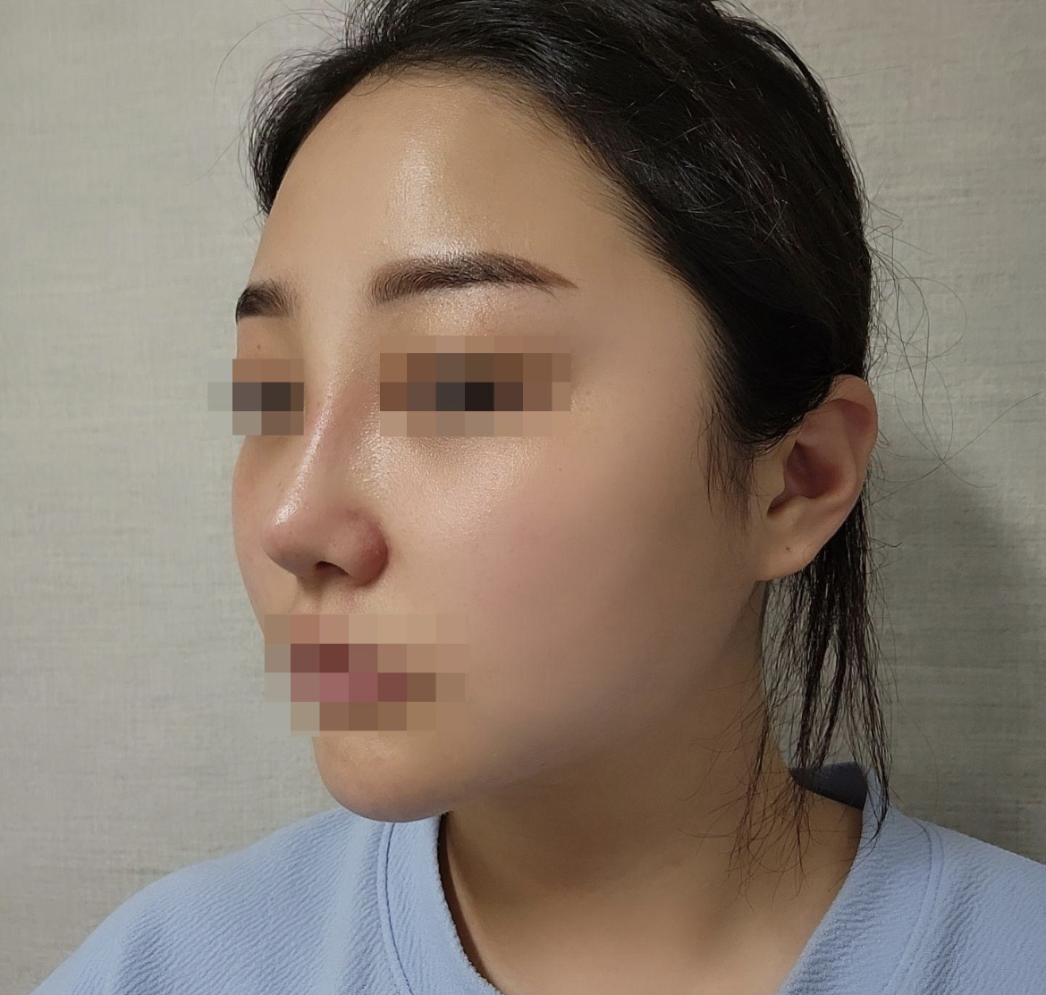 수술후기이미지