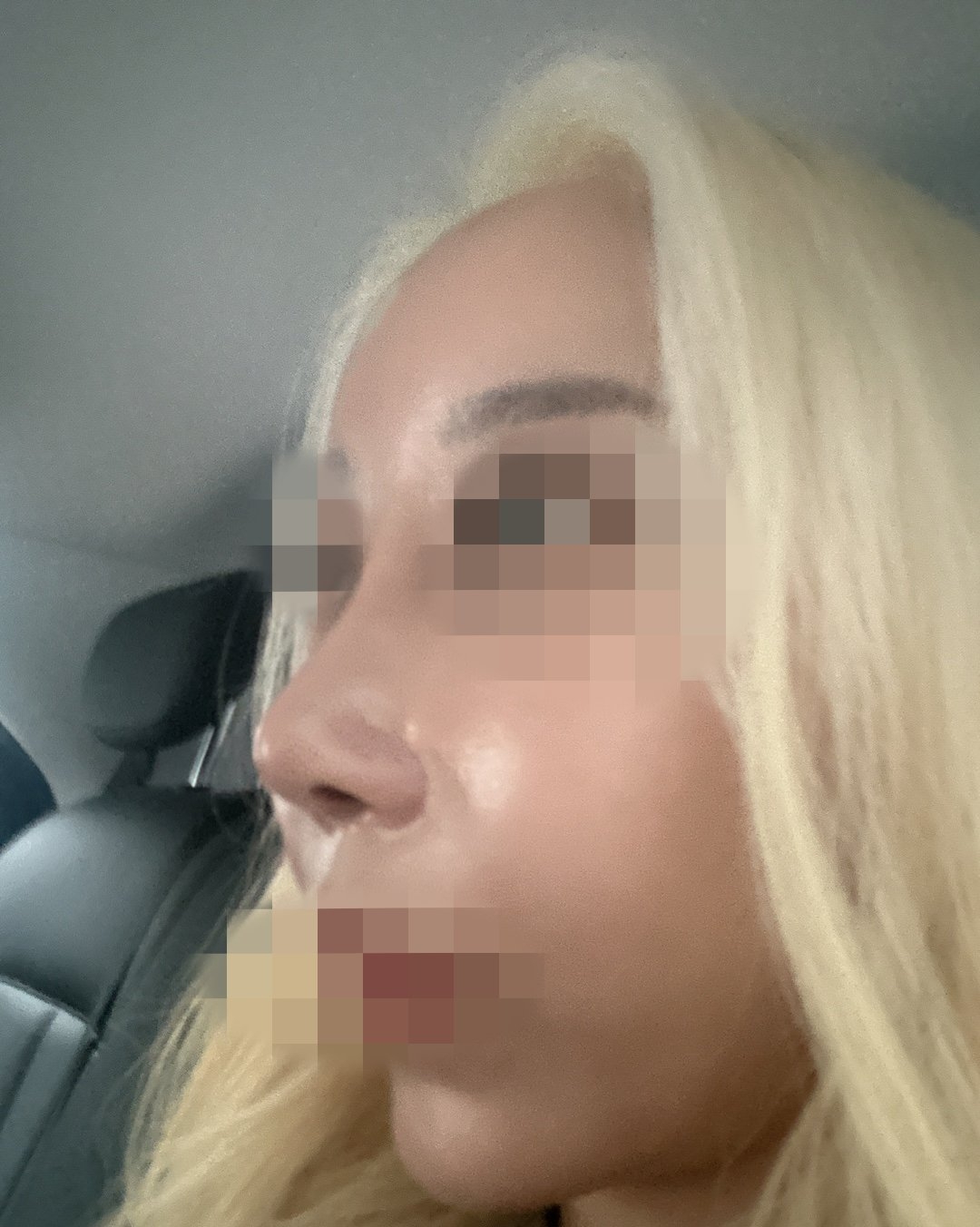 수술후기이미지