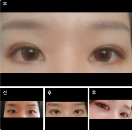 수술후기이미지