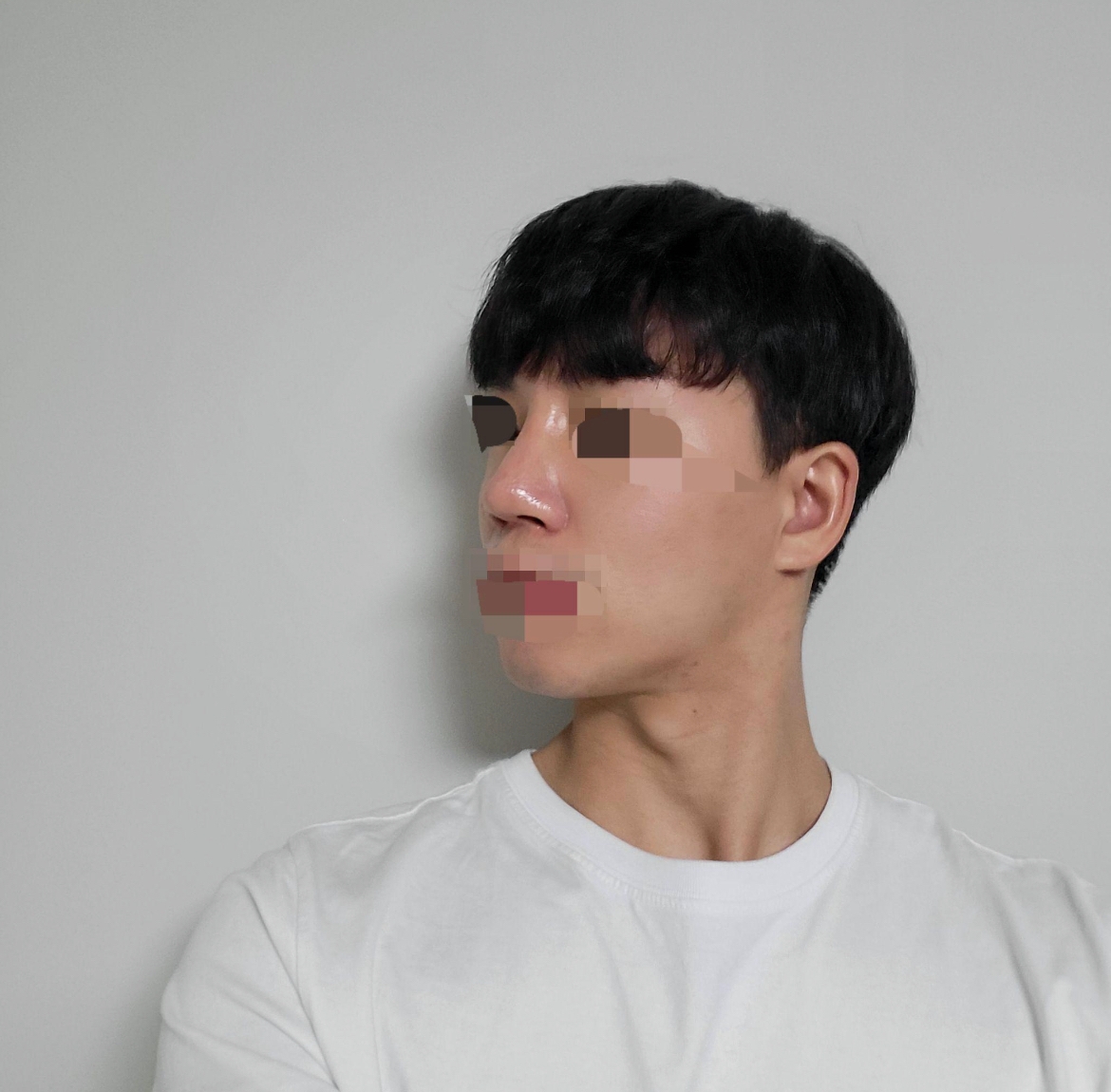 수술후기이미지