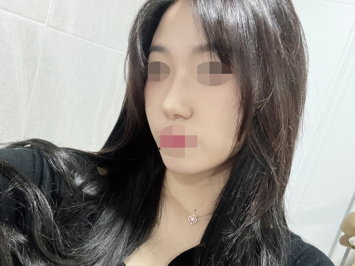 수술후기이미지