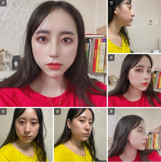 수술후기이미지