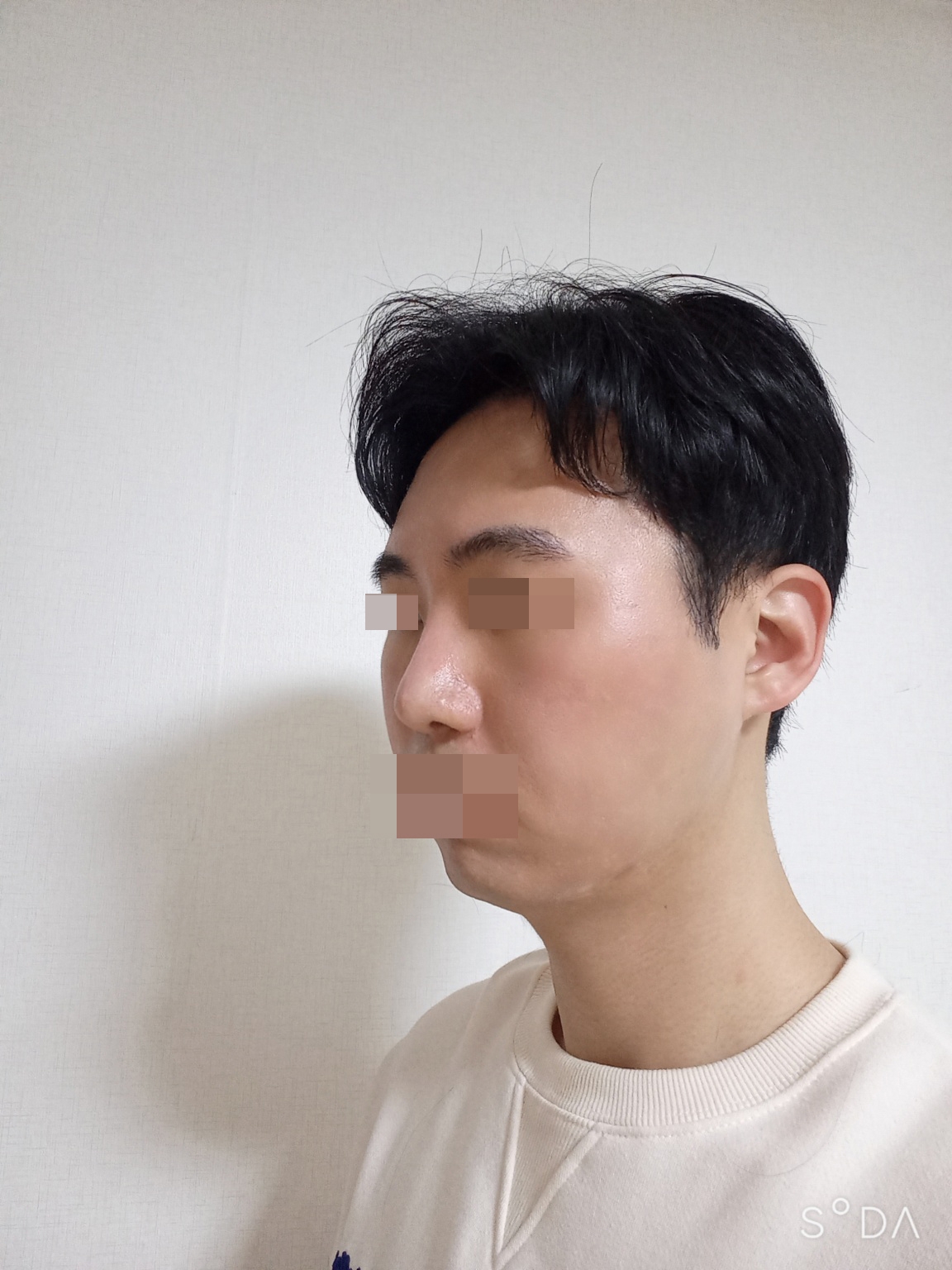 수술후기이미지