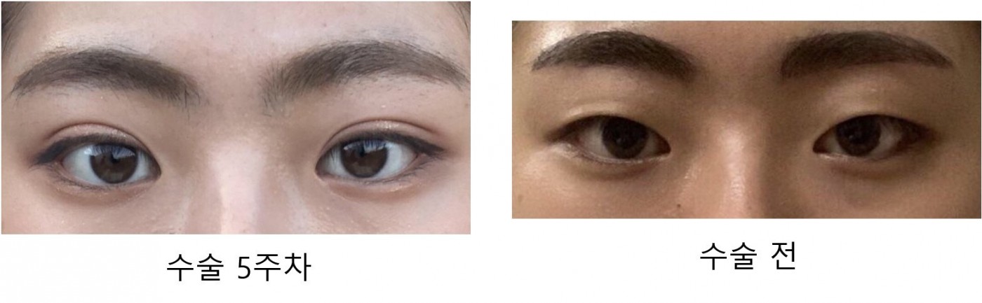 수술후기이미지