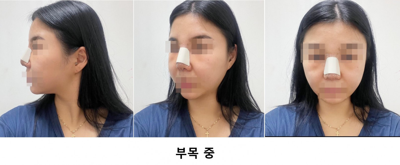 수술후기이미지