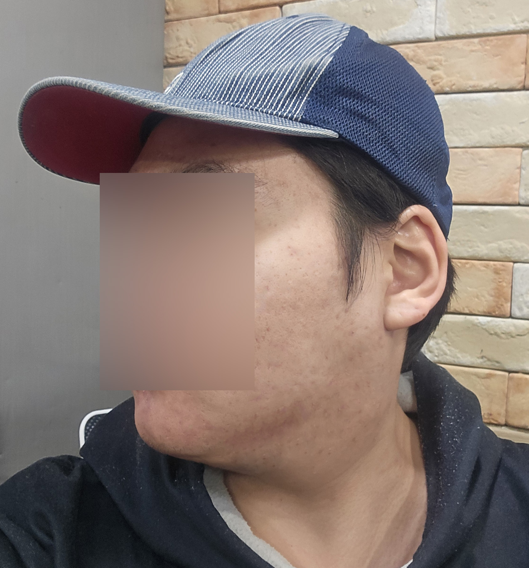수술후기이미지