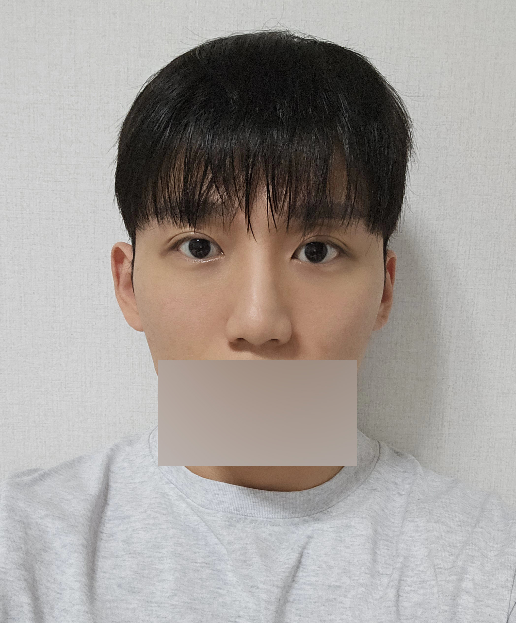 수술후기이미지