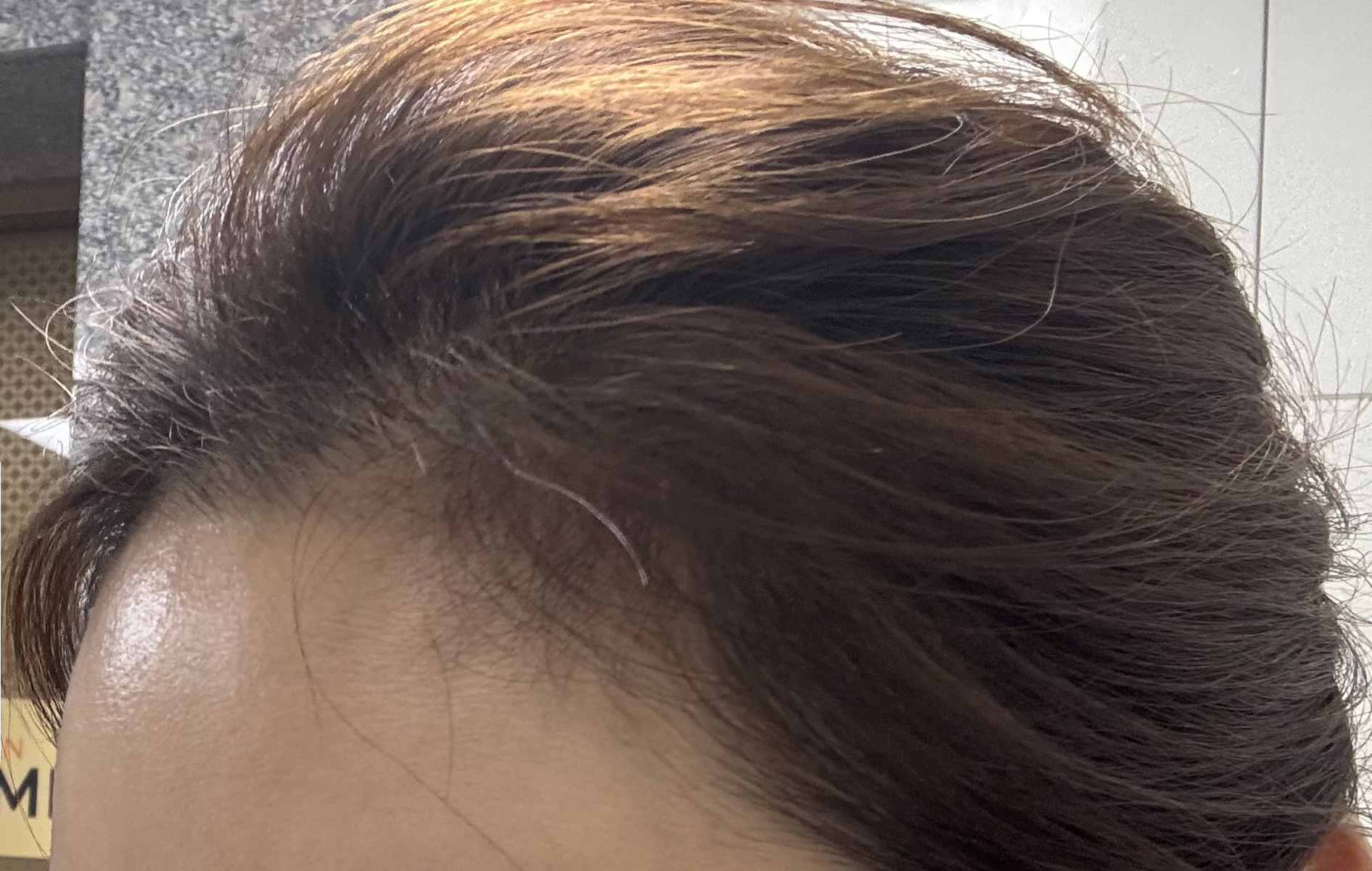 모발이식 후 3개월 만에 달라진 앞머리, 만족스러운 변화!
