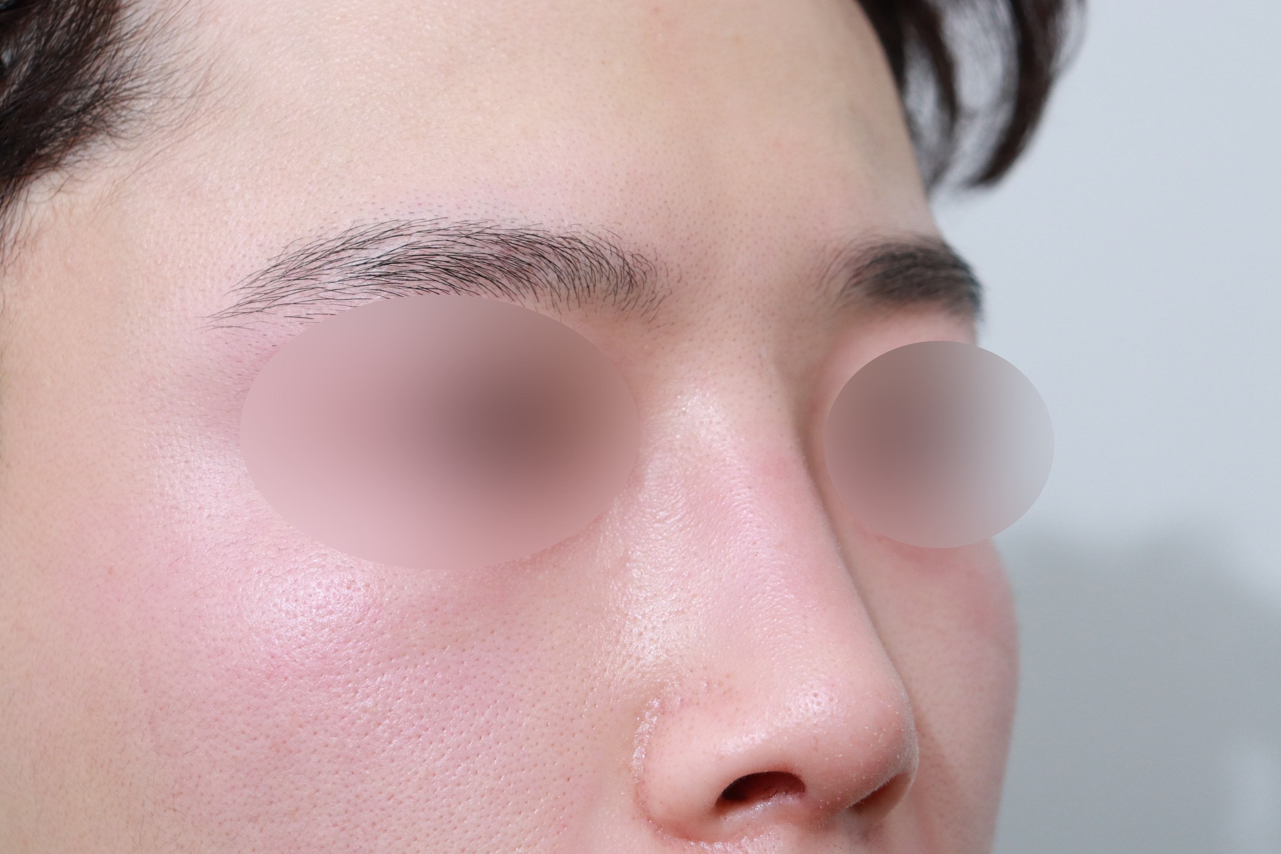 남자 매부리코·코끝 수술 2주차, 자연스럽게 자리 잡는 중입니다.
