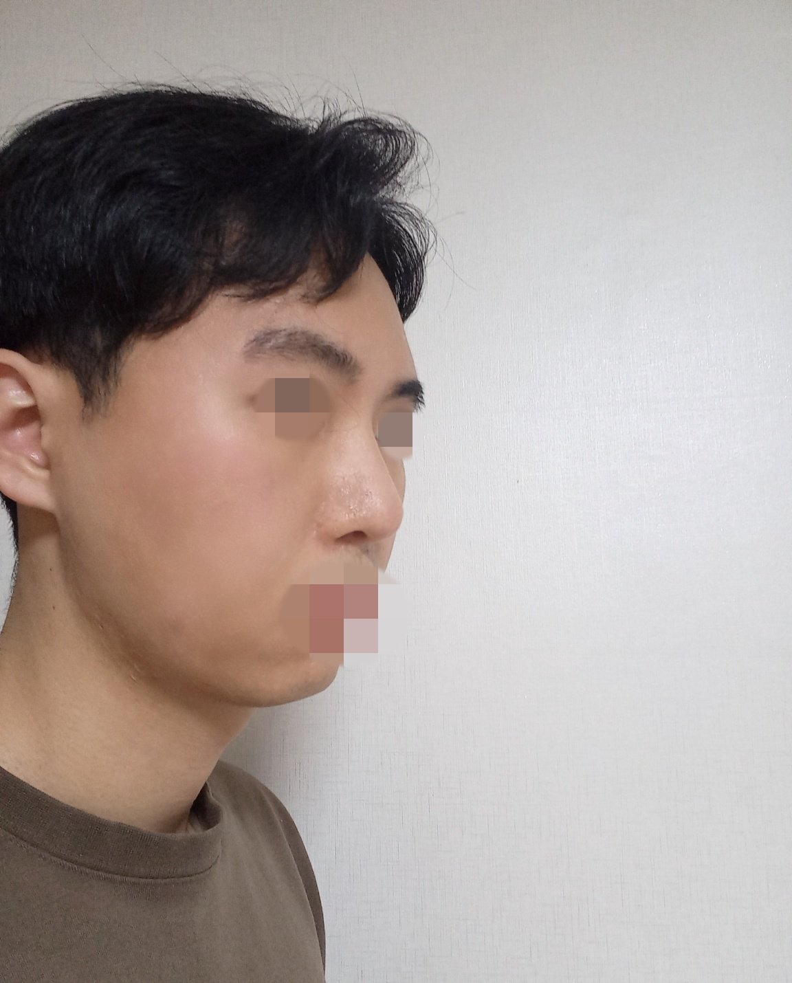 수술후기이미지