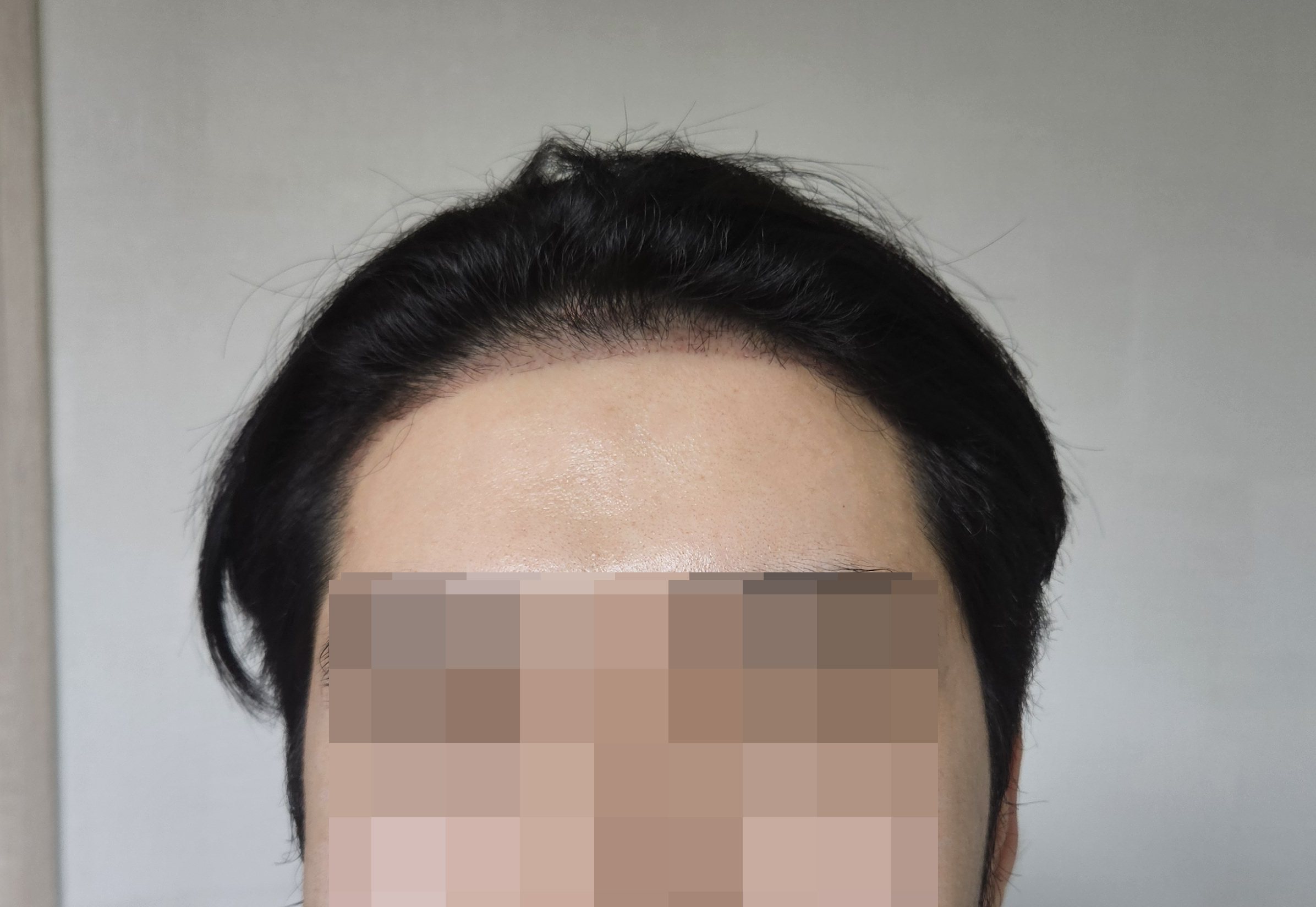 수술후기이미지