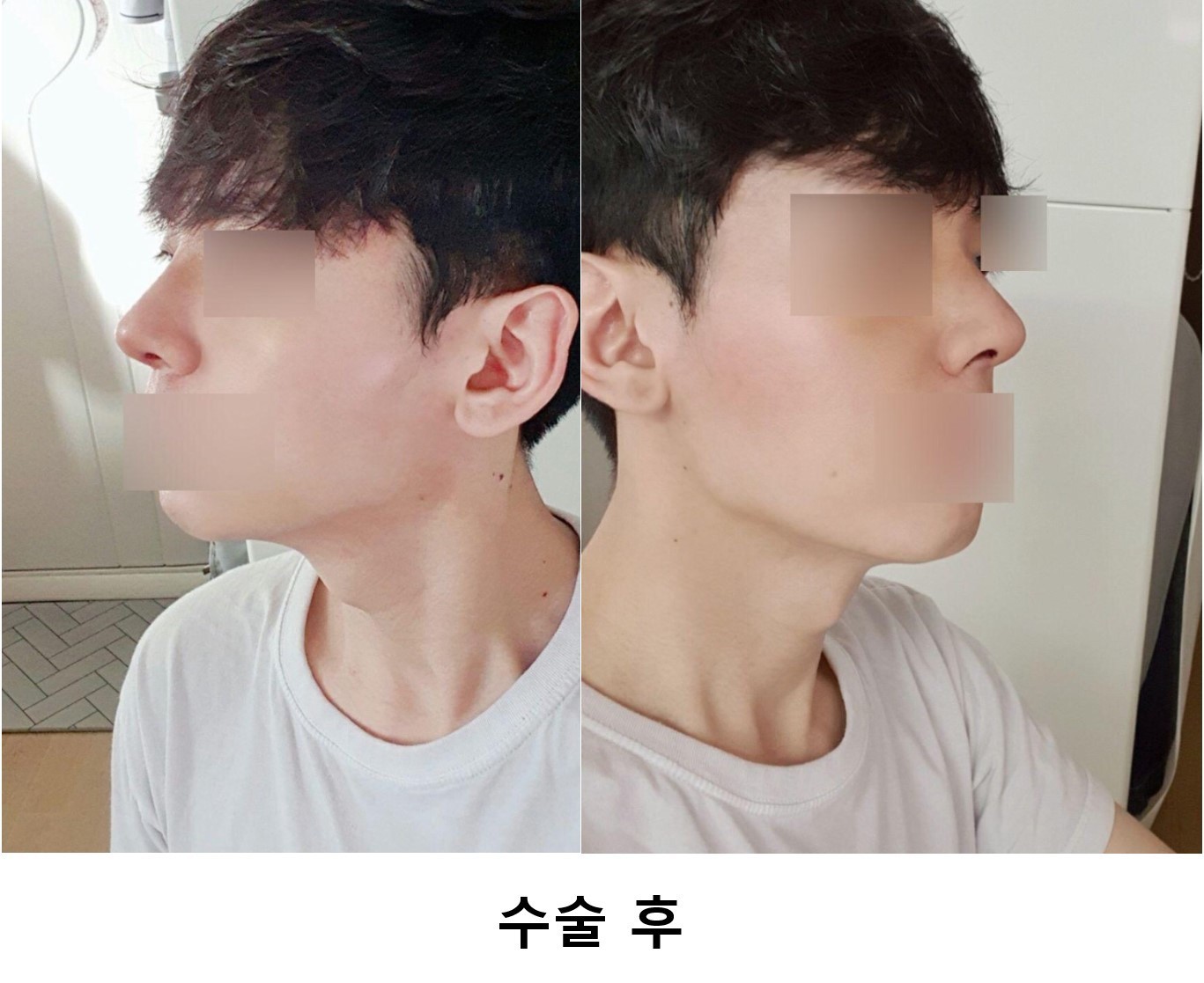 수술후기이미지