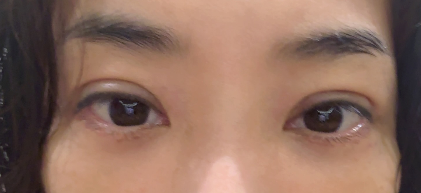 눈밑지방재배치 2주차, 눈가가 한층 밝아졌어요