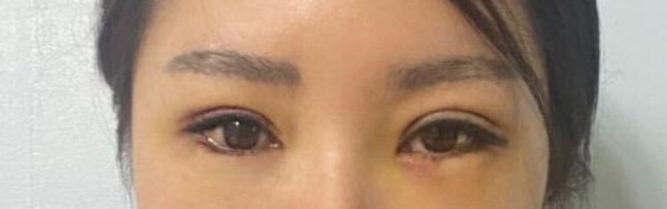 수술후기이미지