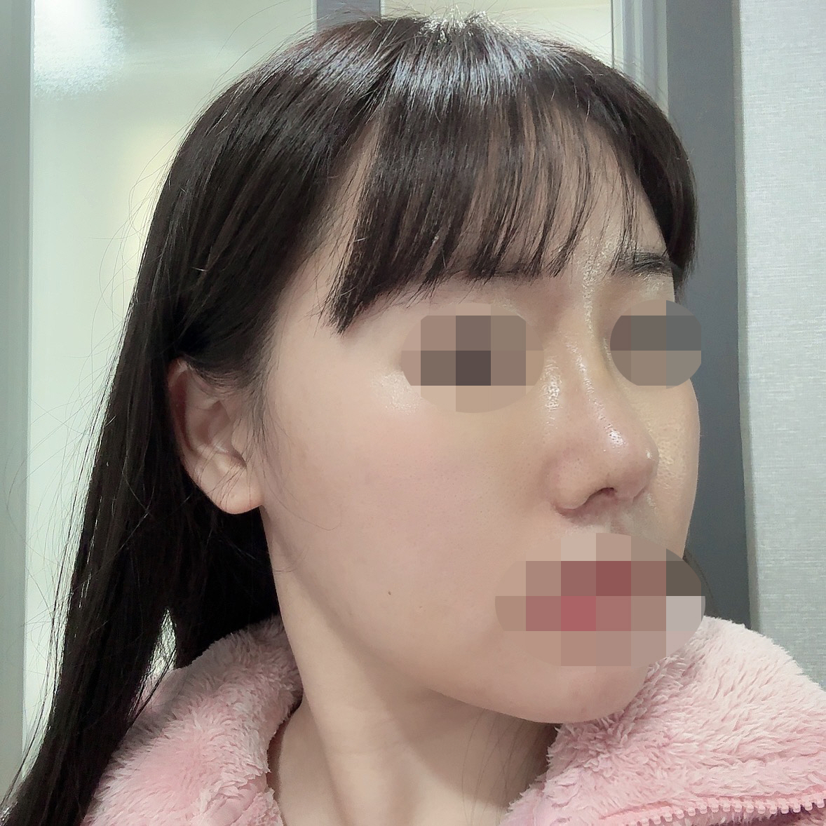 수술후기이미지