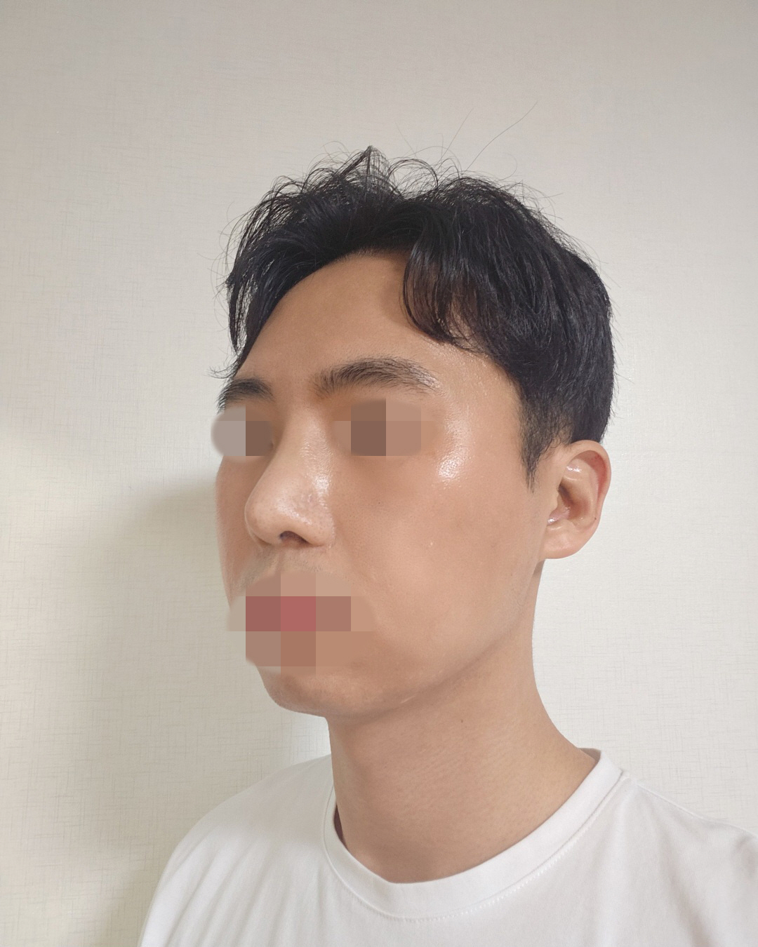 수술후기이미지