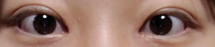 수술후기이미지