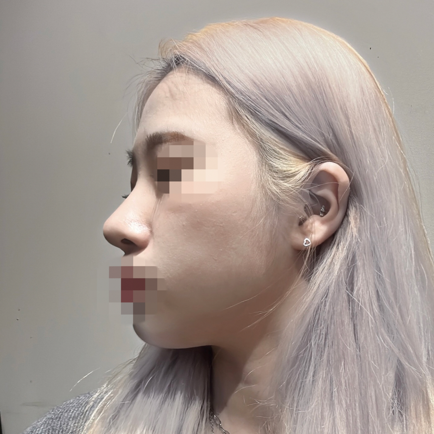 수술후기이미지