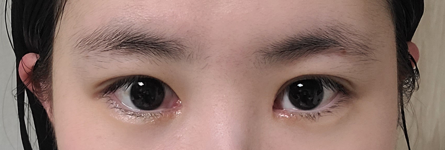 수술후기이미지