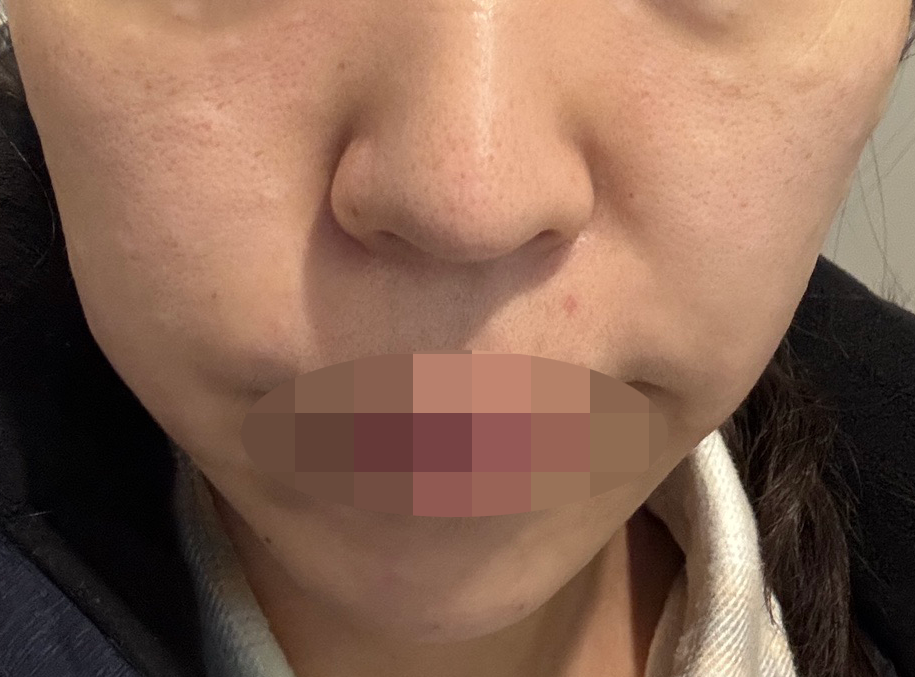 수술후기이미지