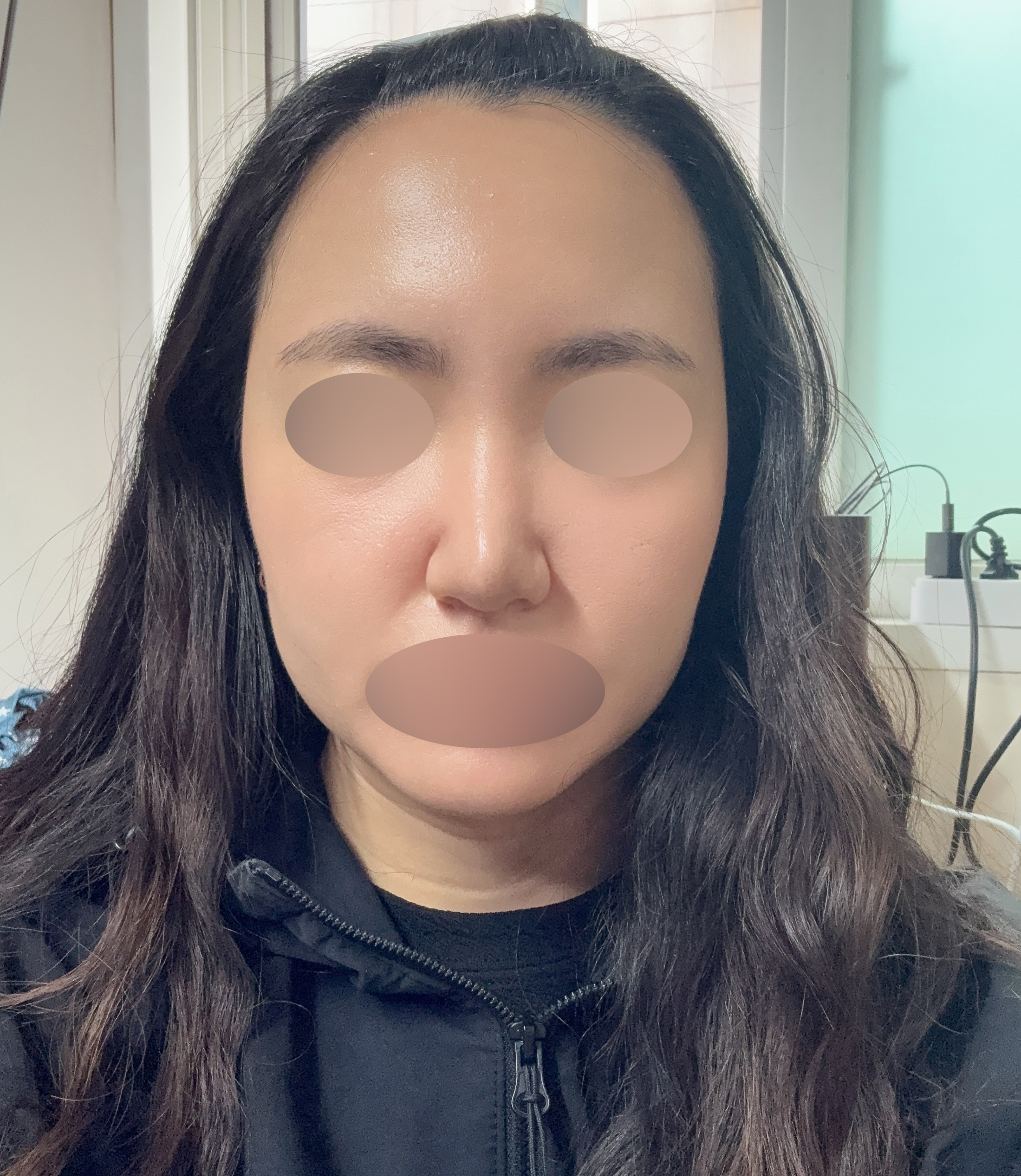 수술후기이미지