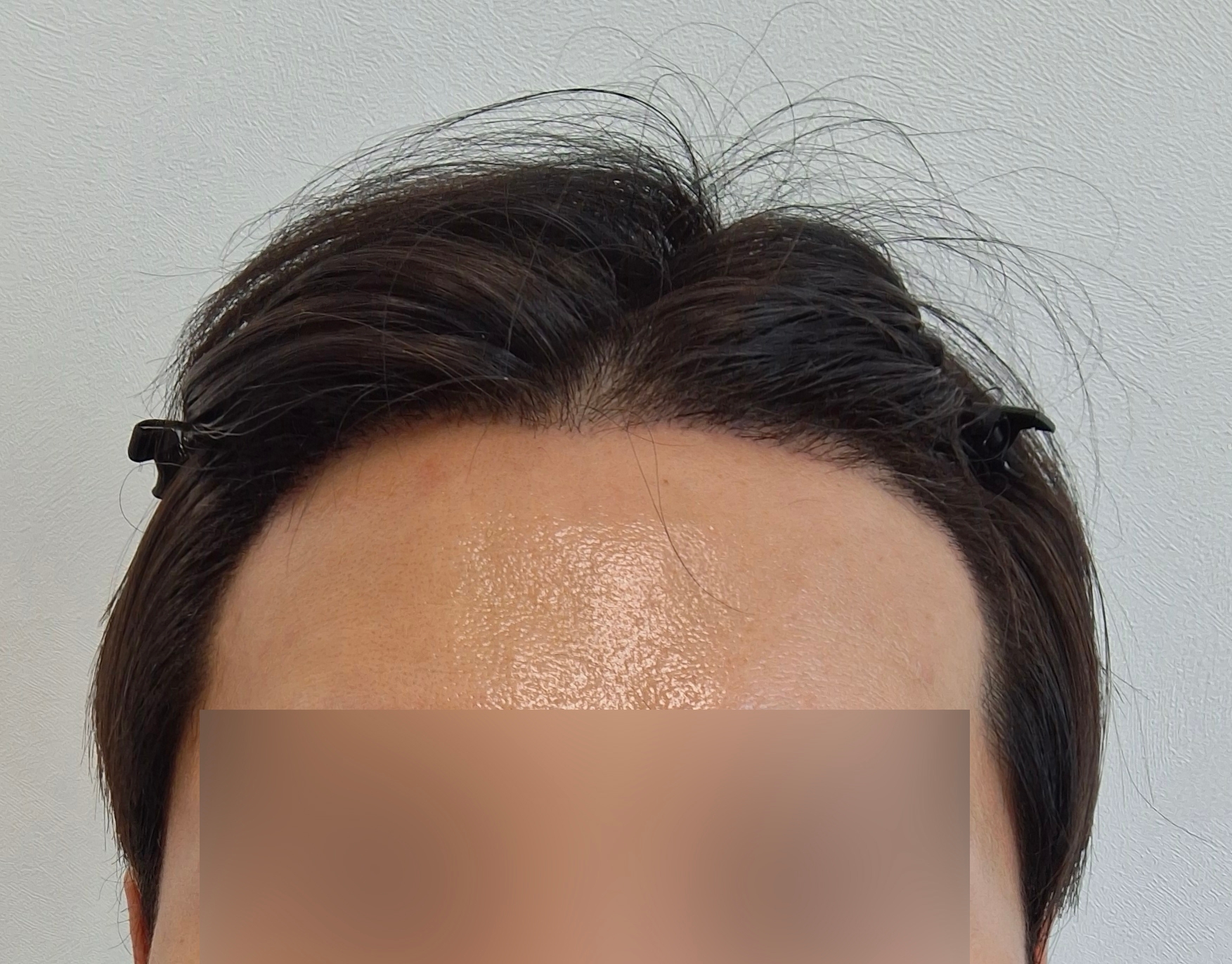 수술후기이미지