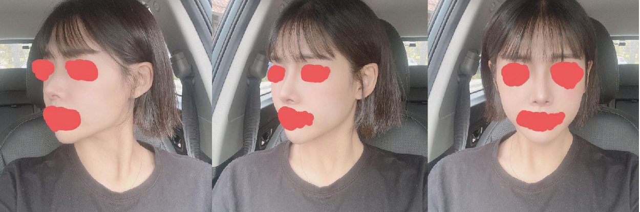 수술후기이미지