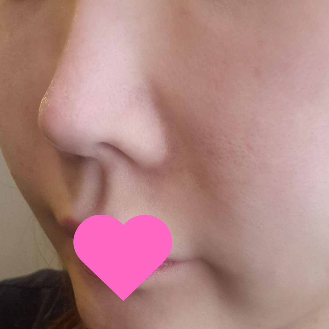 수술후기이미지