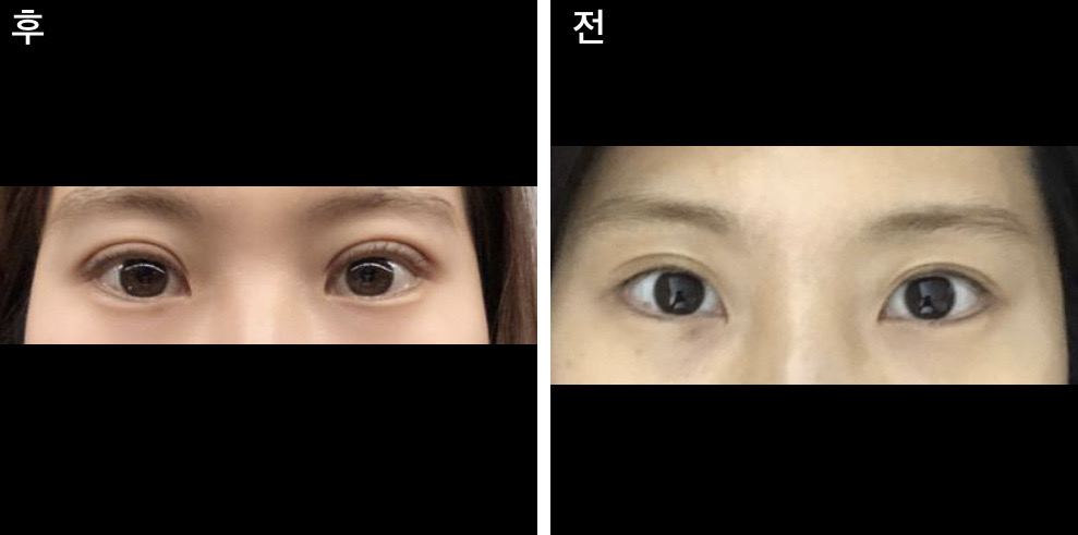 수술후기이미지