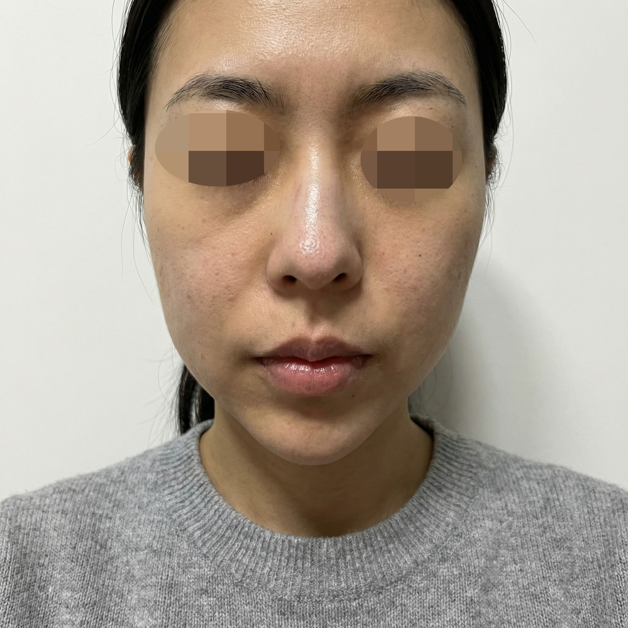 수술후기이미지