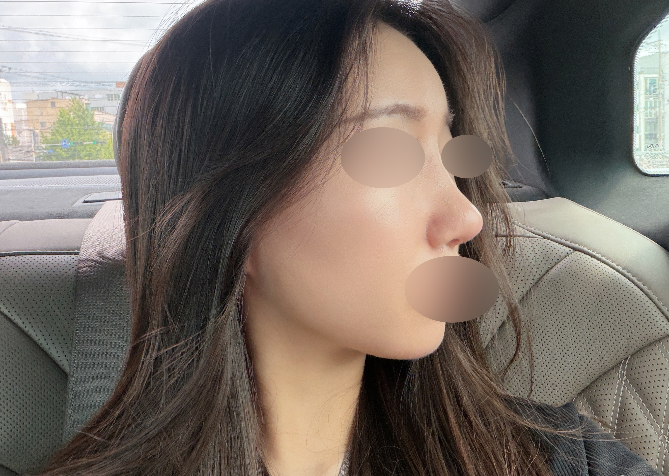 코 재수술 2개월, 점점 만족스러워져요 ⭐