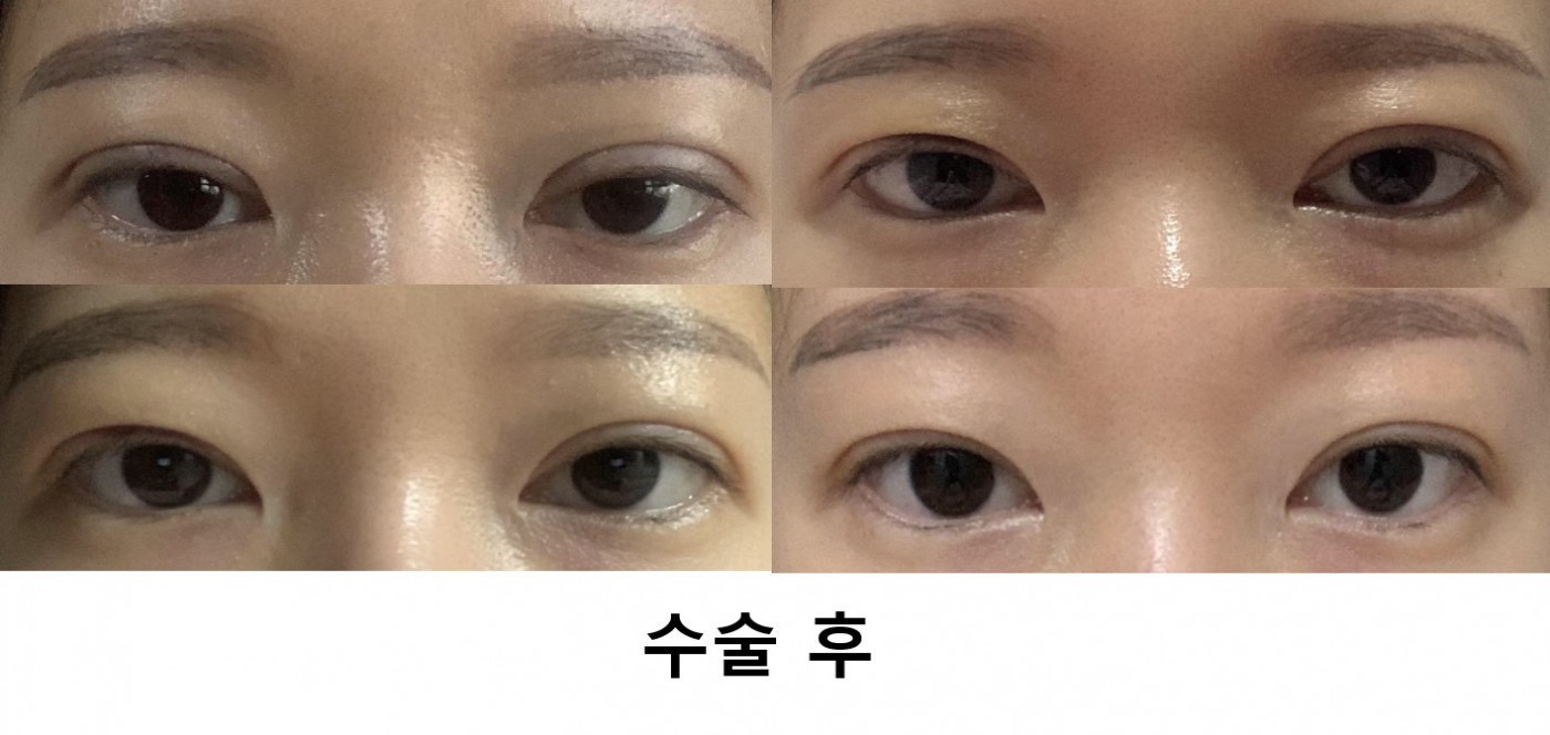 수술후기이미지