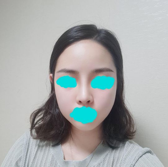 수술후기이미지