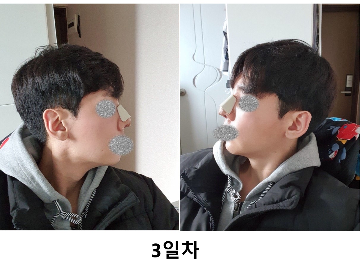 수술후기이미지