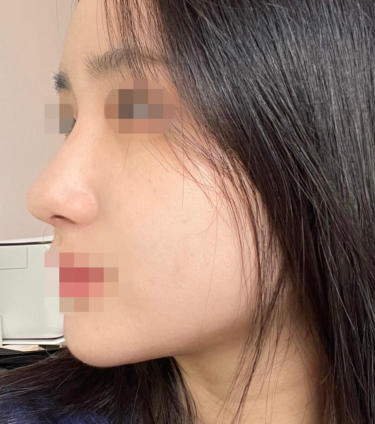 수술후기이미지