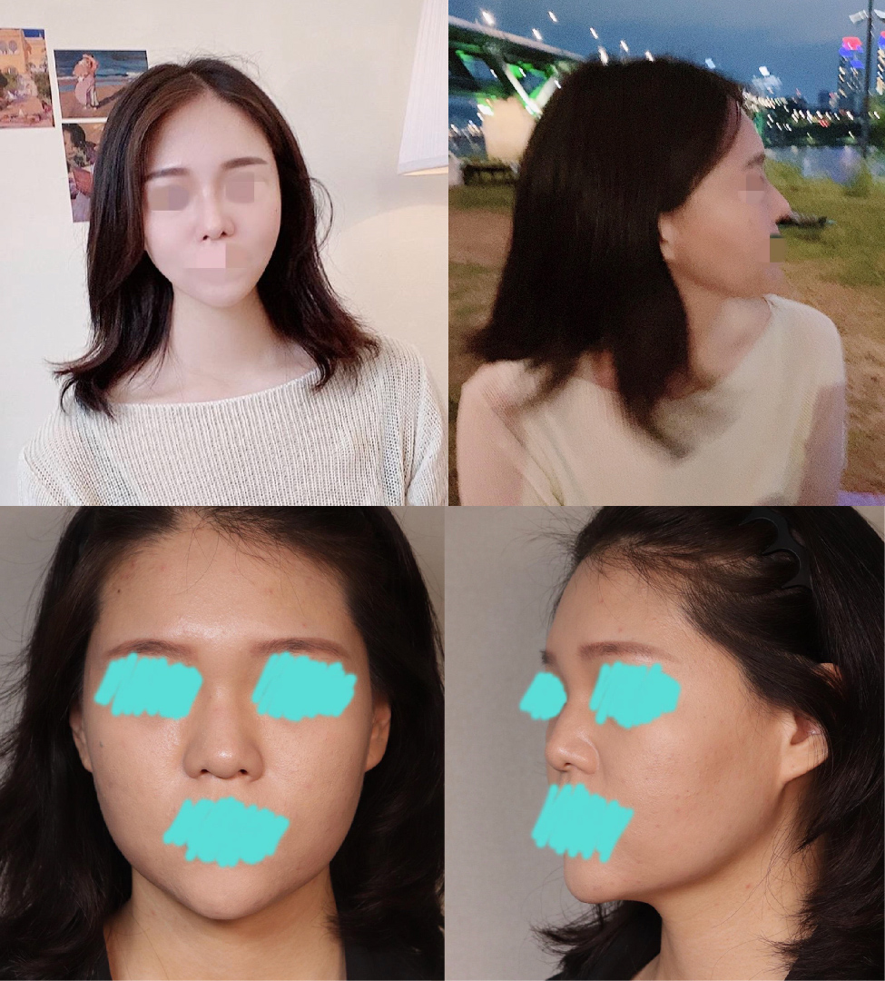 수술후기이미지