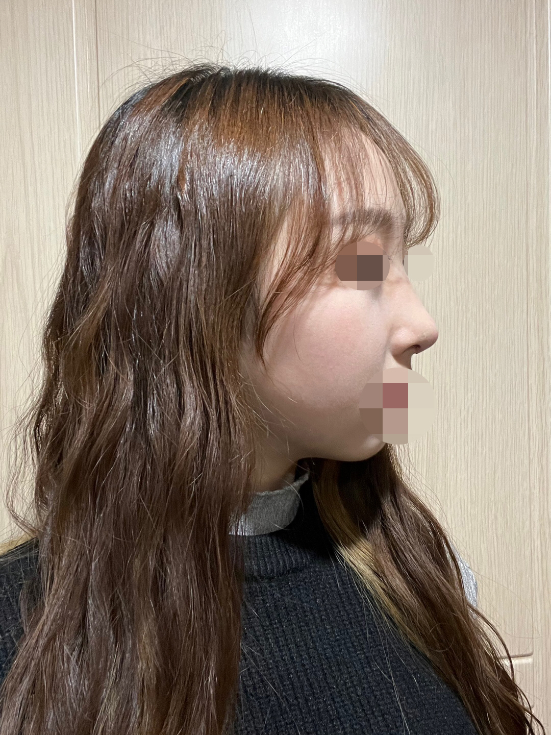 수술후기이미지