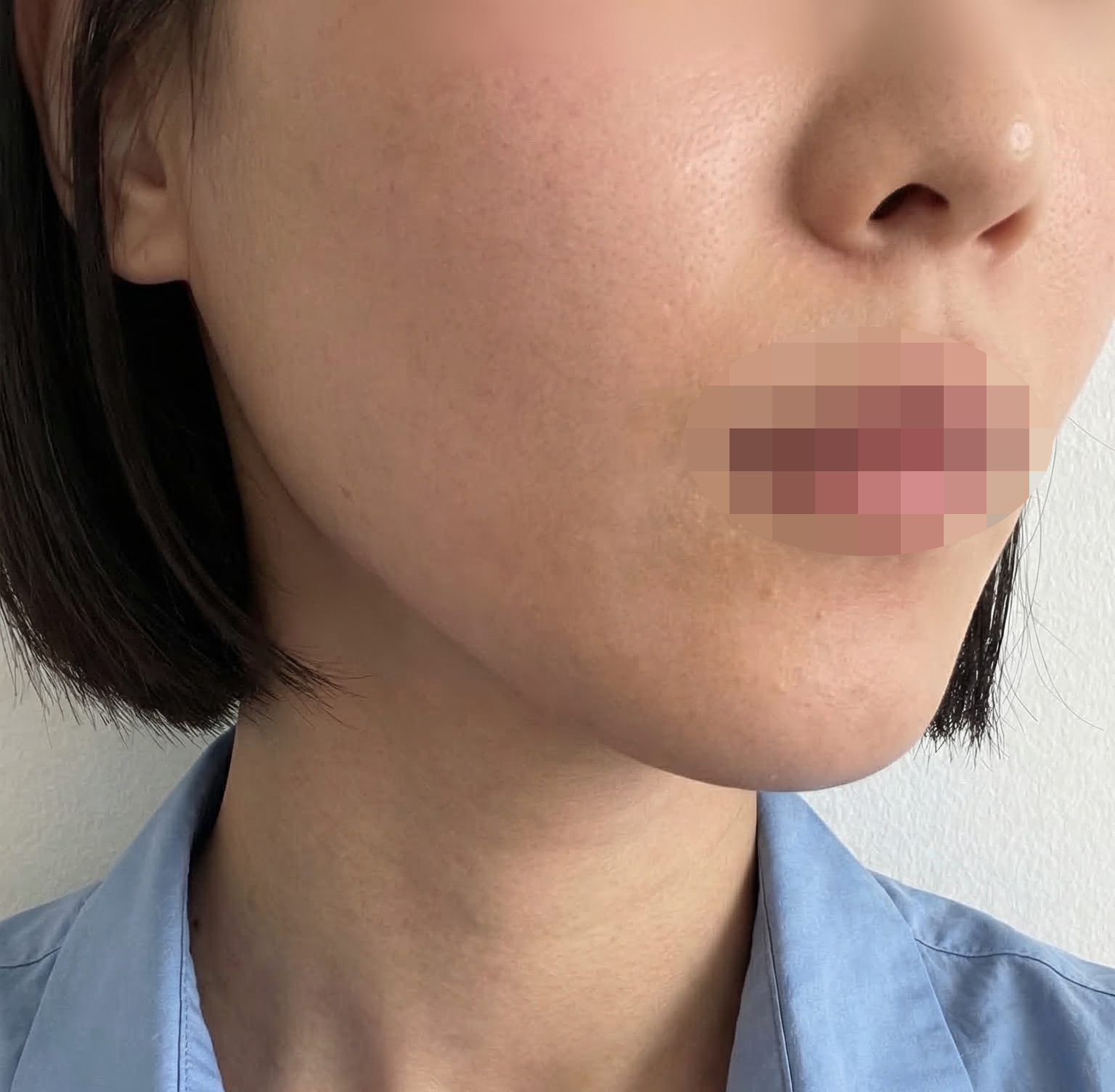 수술후기이미지