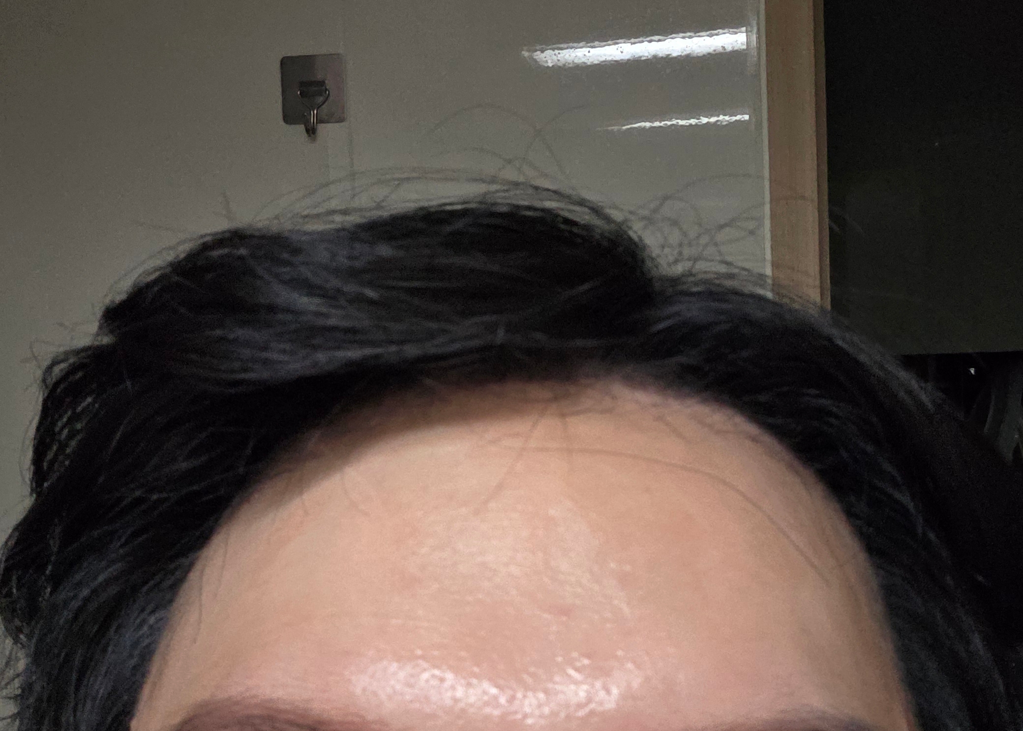 비절개 무삭발 모발이식 2달차, 서울아이를 선택하길 잘했어요
