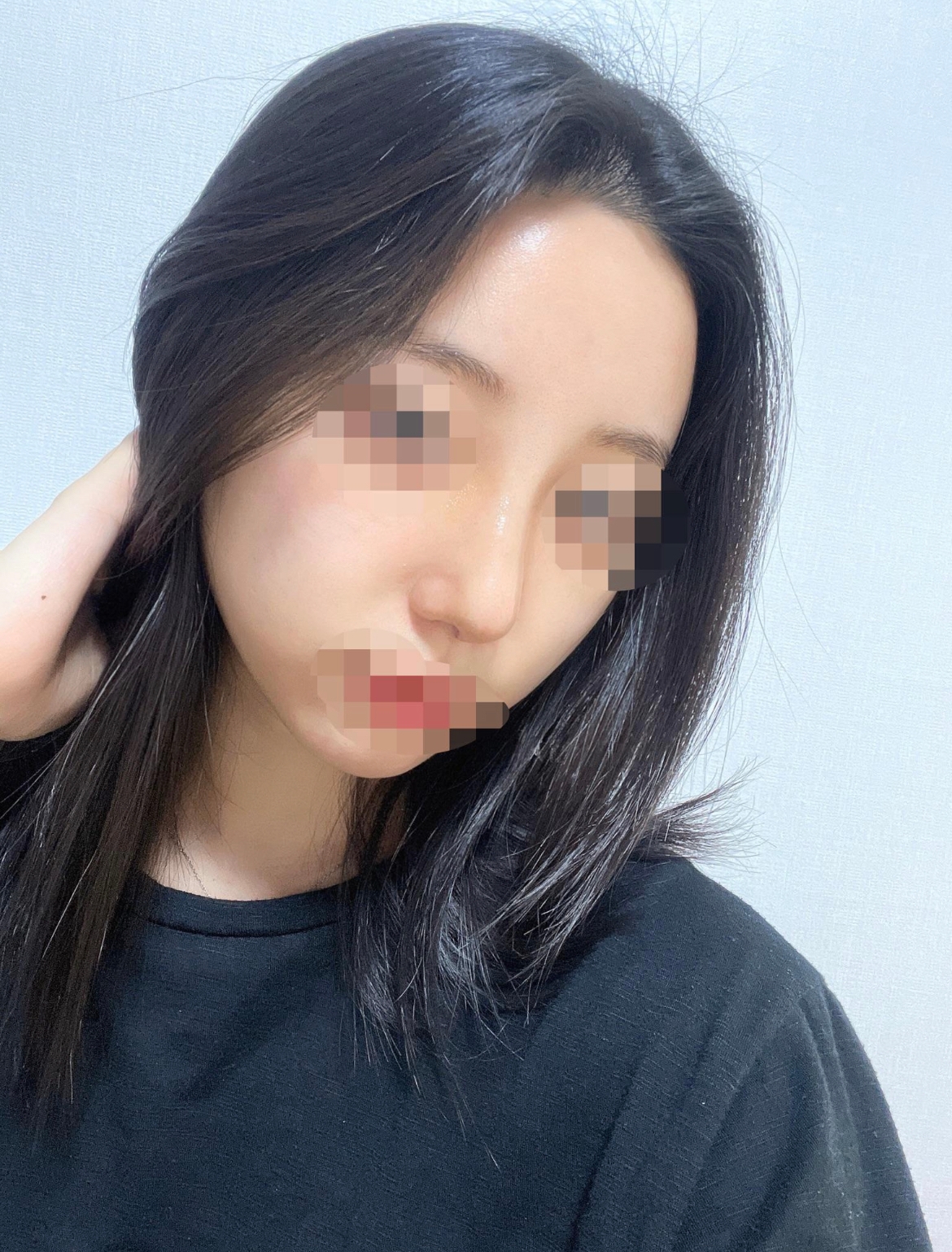 수술후기이미지