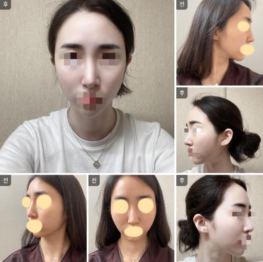 수술후기이미지